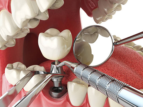 Best Emergency Wisdom Tooth Extraction in West Haven, UT
